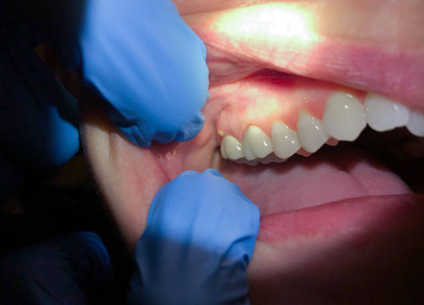Best Emergency Treatment for Dental Infections or Abscesses in South San Francisco, CA