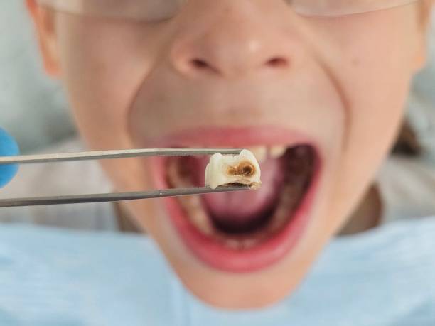 Best Emergency Tooth Extraction in South San Francisco, CA