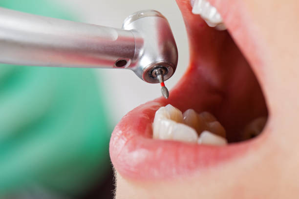 Best Emergency Treatment for Dental Infections or Abscesses in South San Francisco, CA